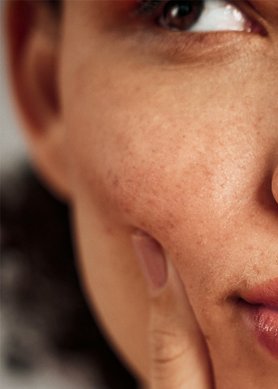 PIGMENTATION