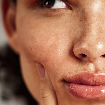 PIGMENTATION